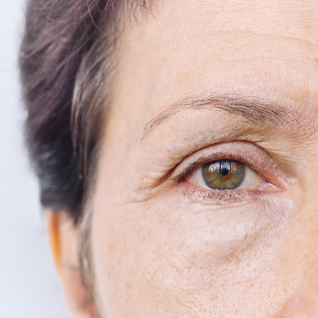 Blepharoplasty