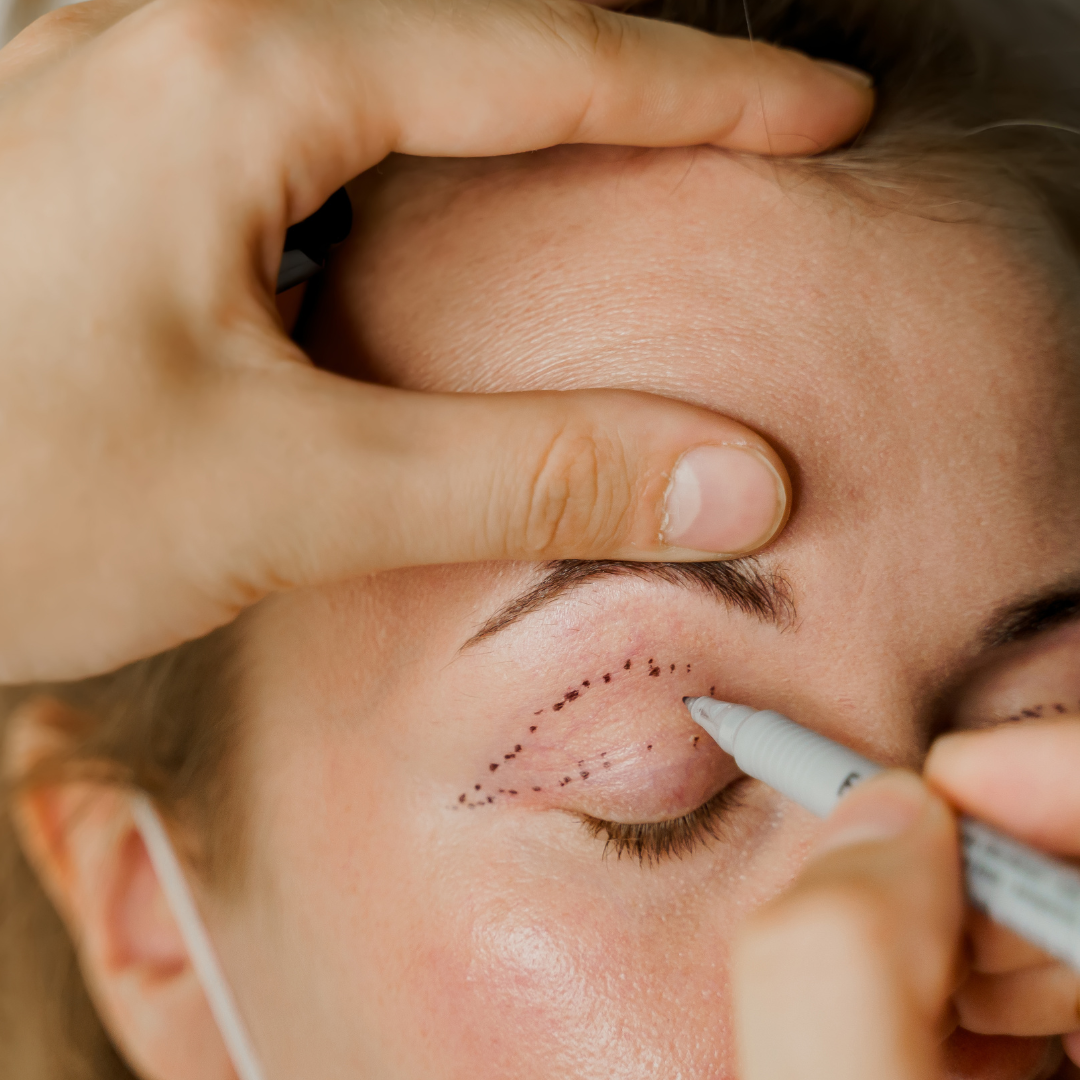 Blepharoplasty