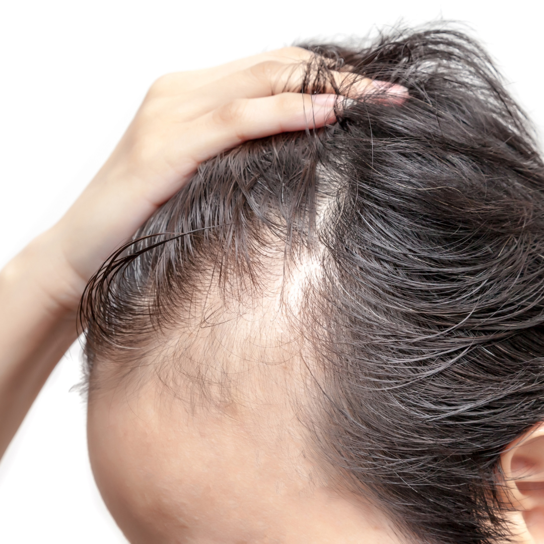 Hair transplant