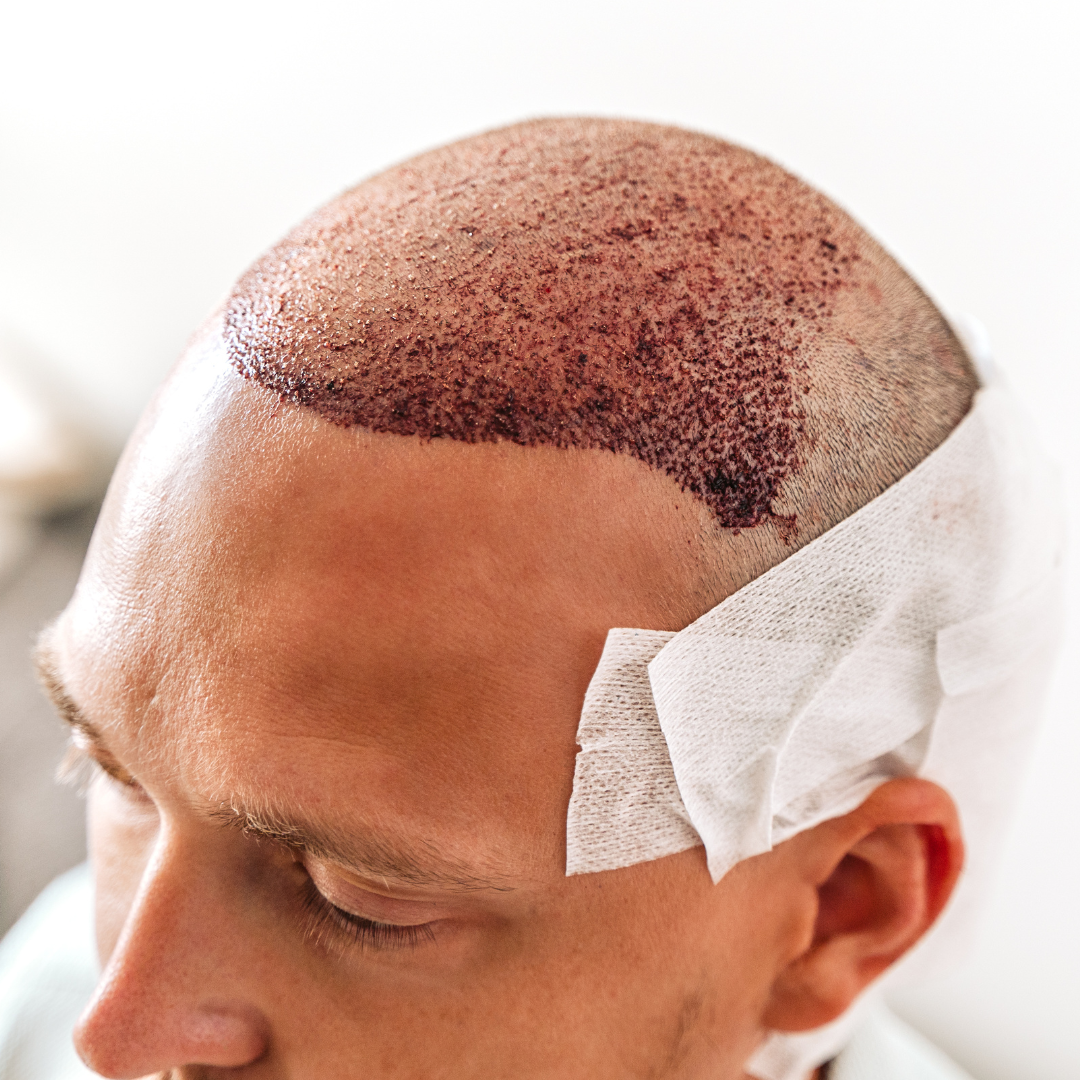 Hair transplant